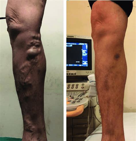 varicose veins with gsv